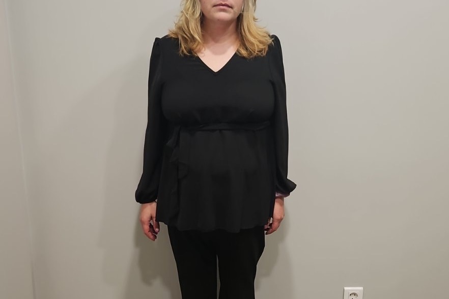 След бариатричната хирургия