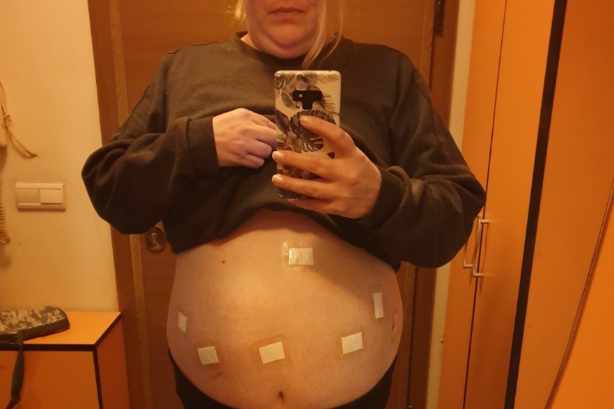 Преди бариатричната хирургия